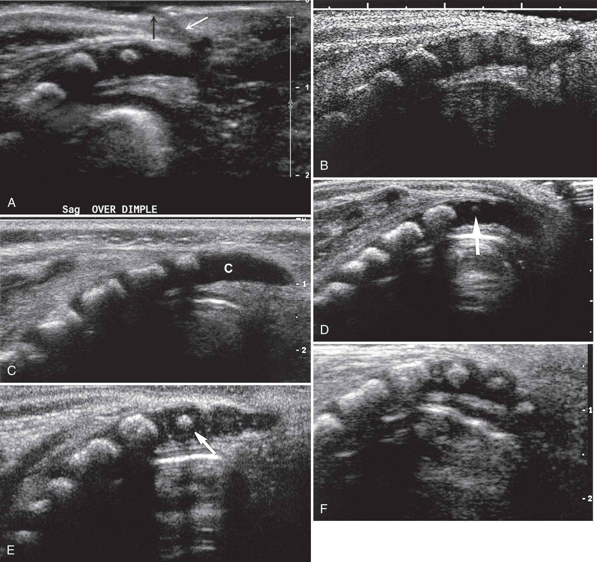 FIG. 49.12, Variation in Normal Development of Coccyx in Six Infants.