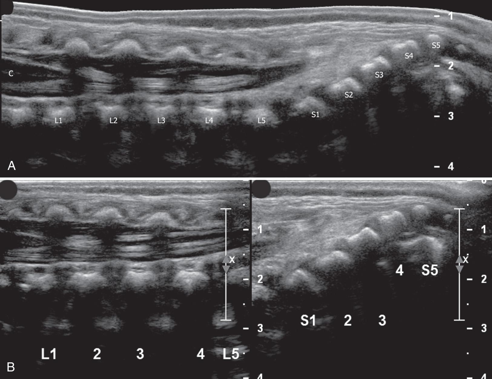 FIG. 49.3, Lumbosacral Spine in a 2-Week-Old Infant.