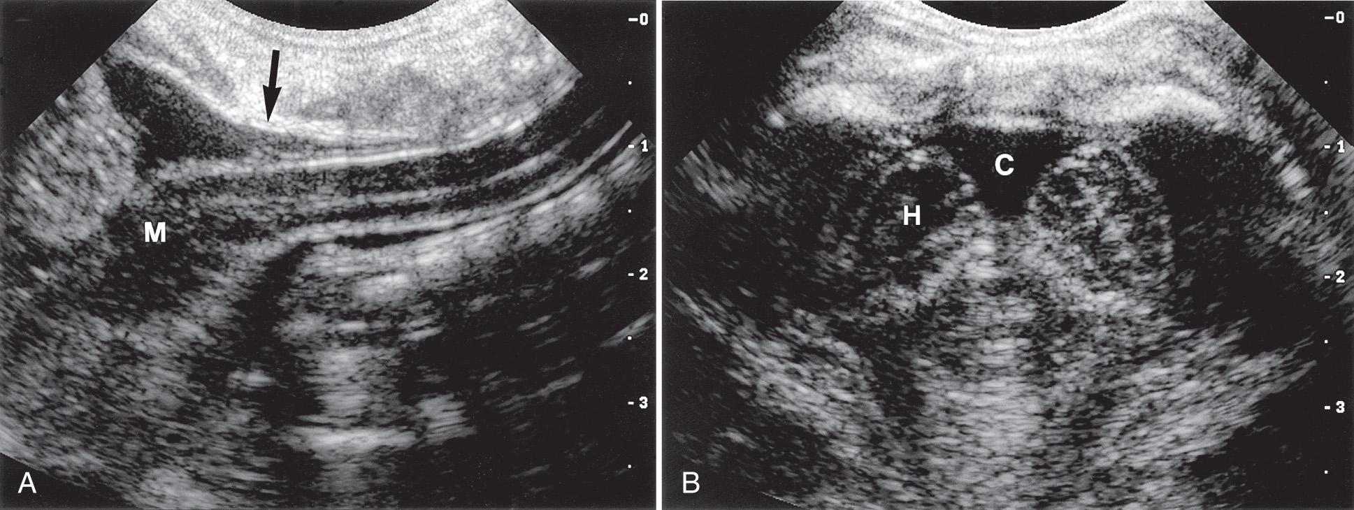 FIG. 49.4, Brainstem, Cisterna Magna, and Cerebellar Hemispheres.