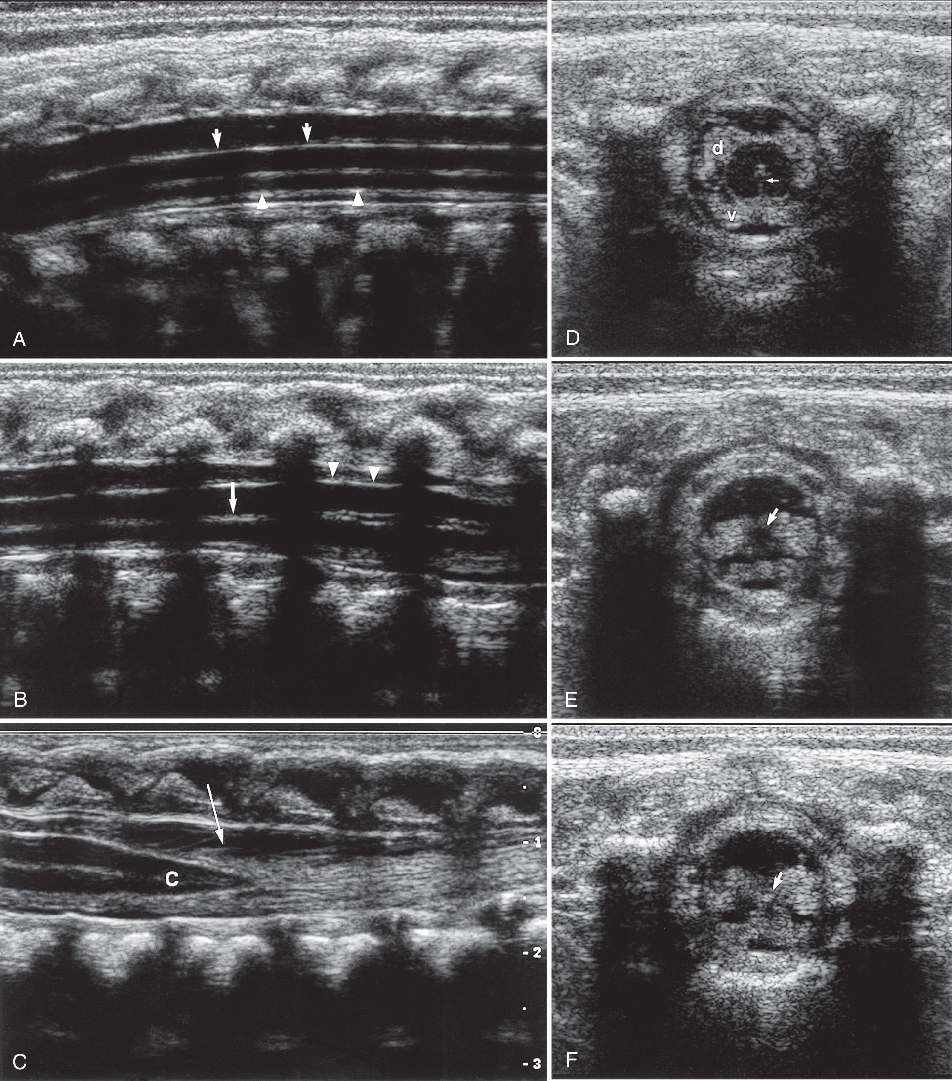 FIG. 49.5, Normal Spinal Cord.