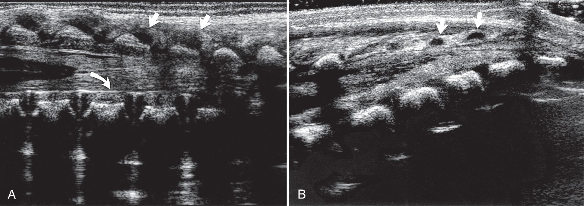 FIG. 49.6, Normal Vertebral Sonographic Anatomy.