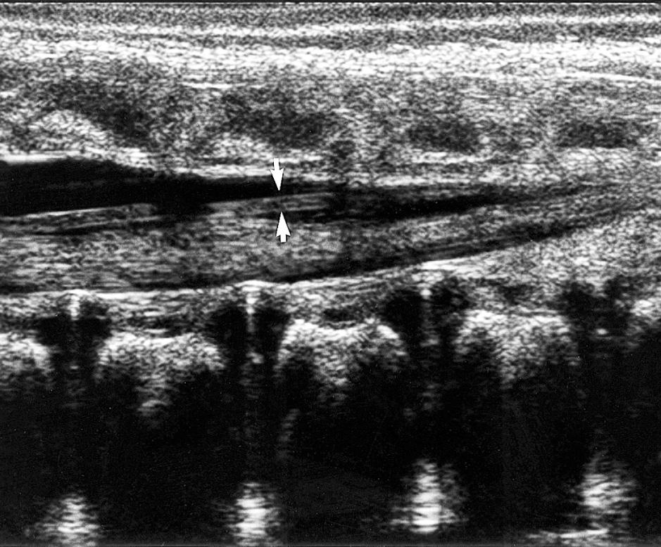 FIG. 49.8, Normal Filum Terminale.