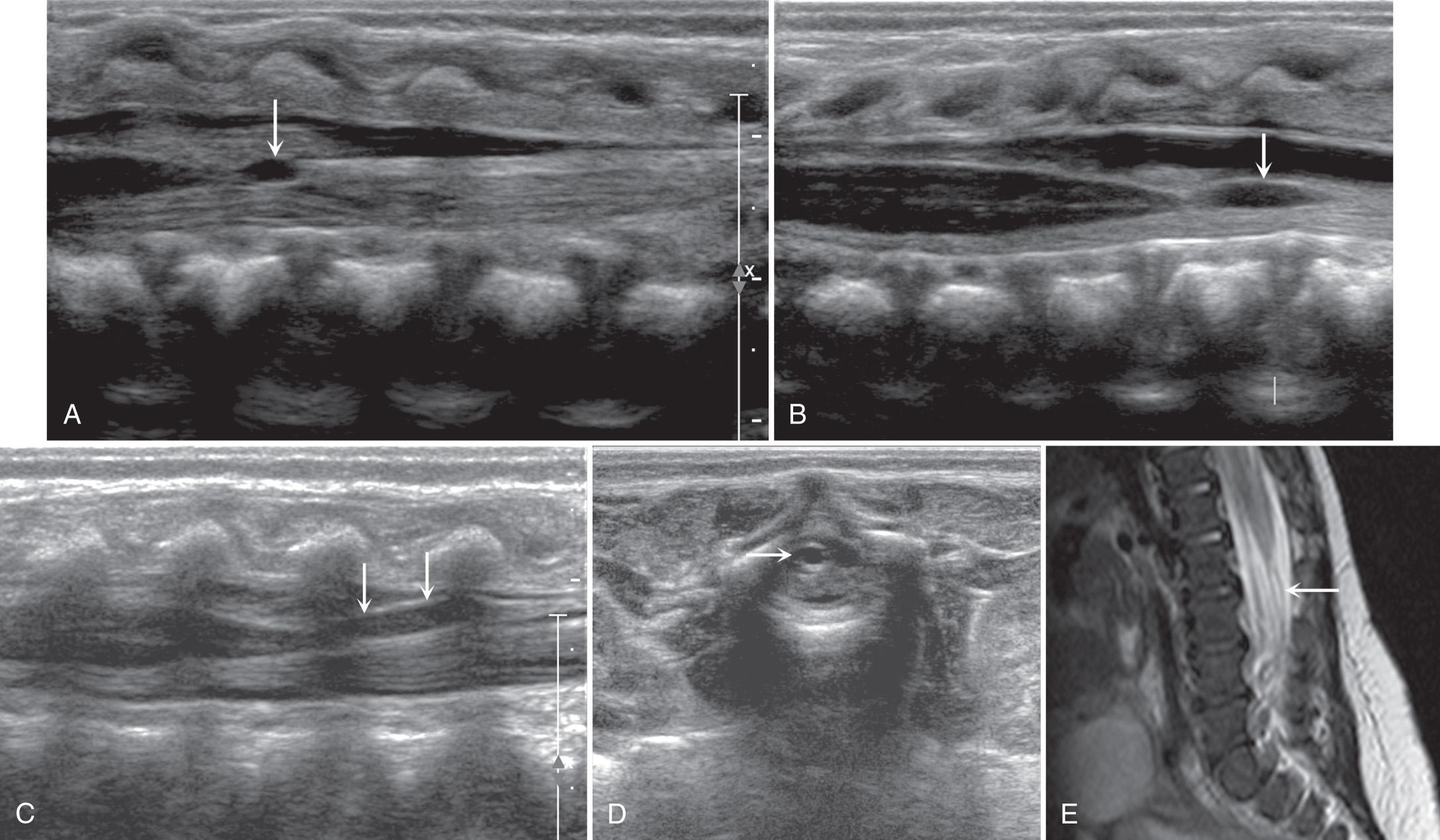 FIG. 49.9, Filar Cysts.