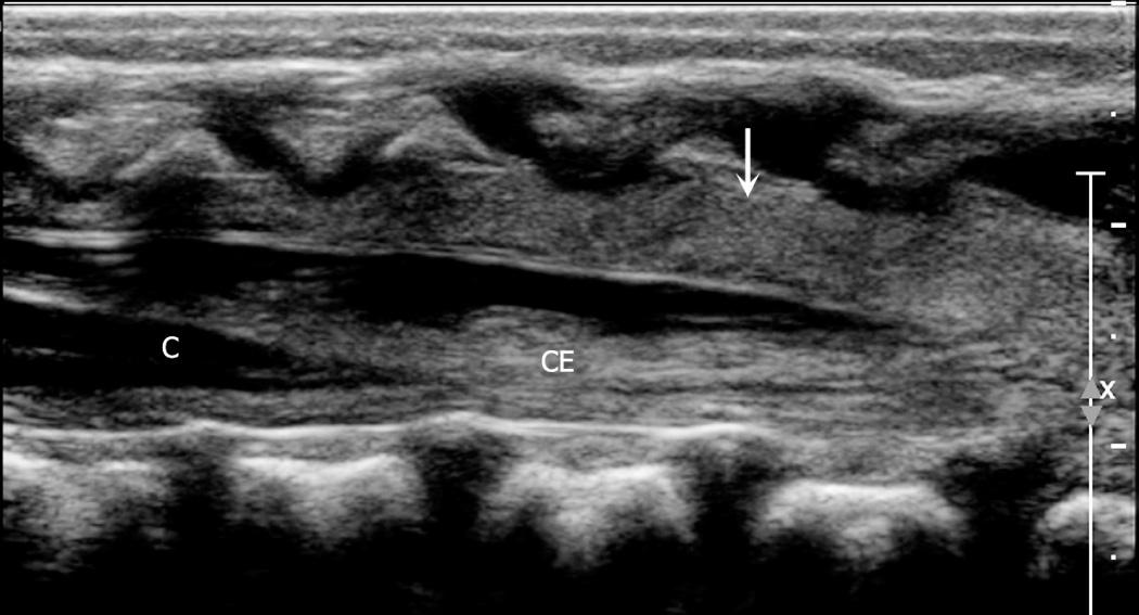 FIG. 49.10, Normal Epidural Fat.