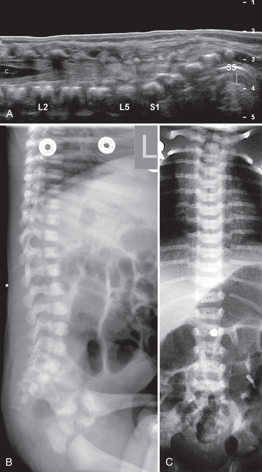 FIG. 49.11, Determining Level of Conus Medullaris.