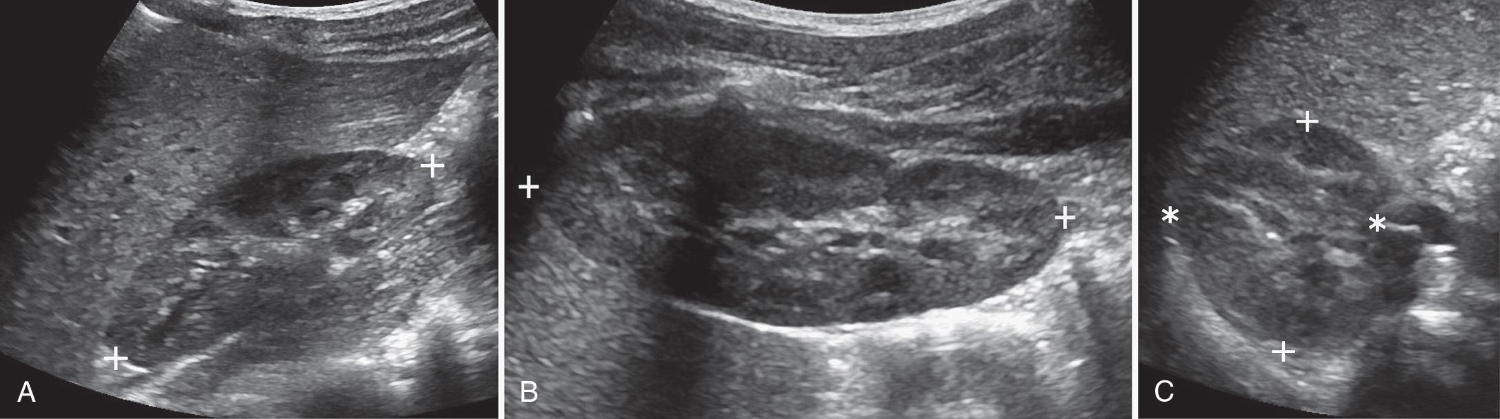 FIG. 52.1, Renal Length and Volume.