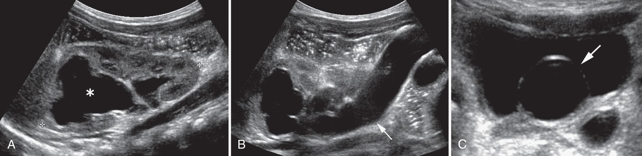 FIG. 52.11, Renal Duplication With Ectopic Ureterocele of Upper-Pole Moiety.