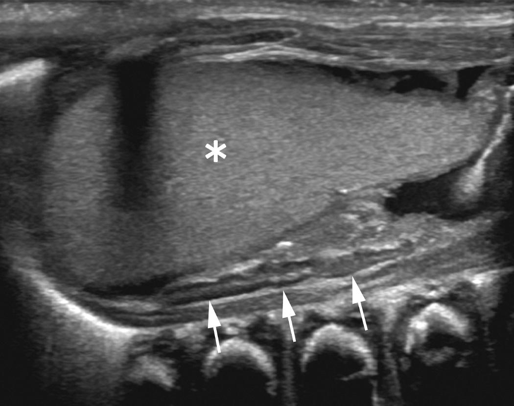 FIG. 52.12, “Lying Down” Adrenal Sign in a Neonate With Absence of the Left Kidney.