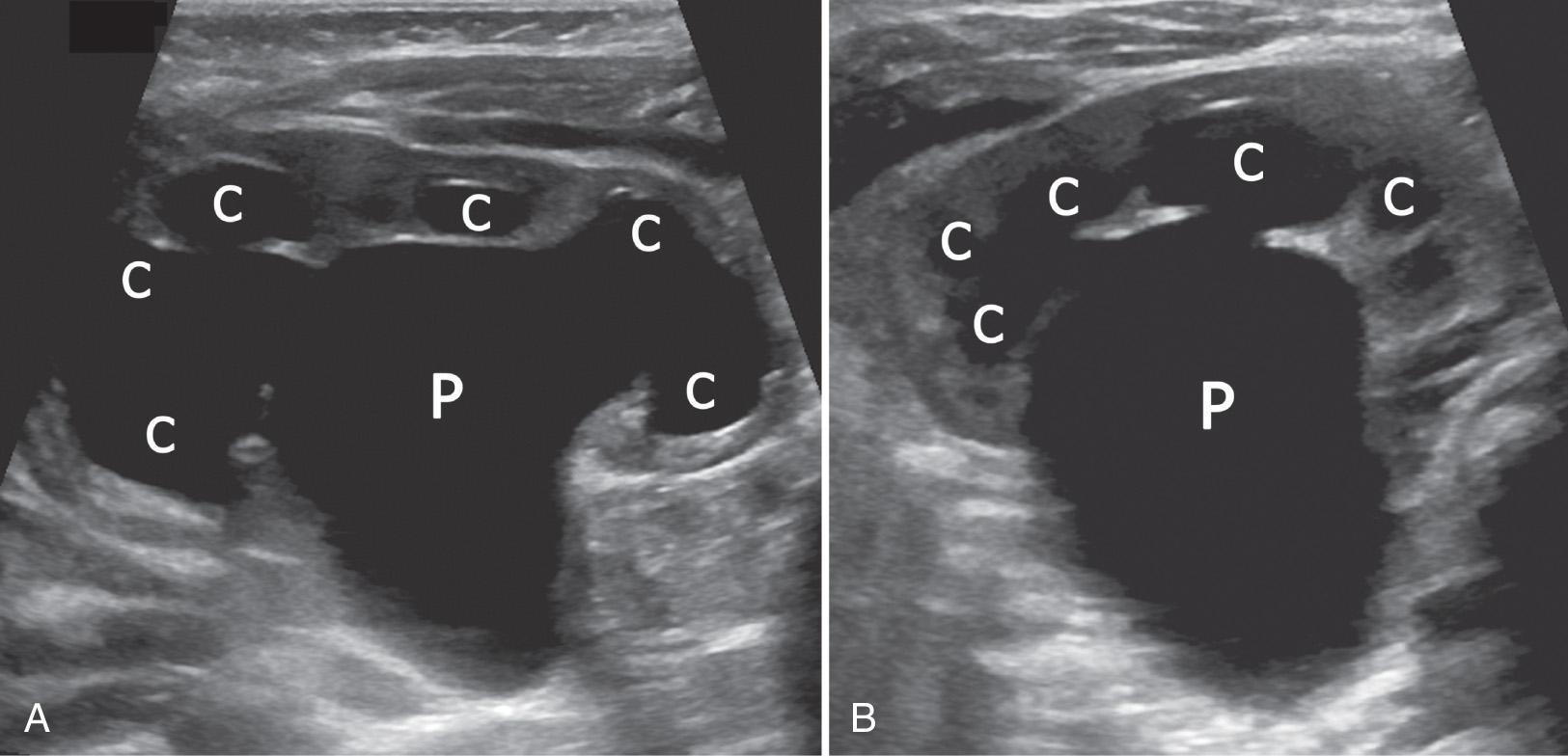 FIG. 52.17, Ureteropelvic Junction Obstruction.