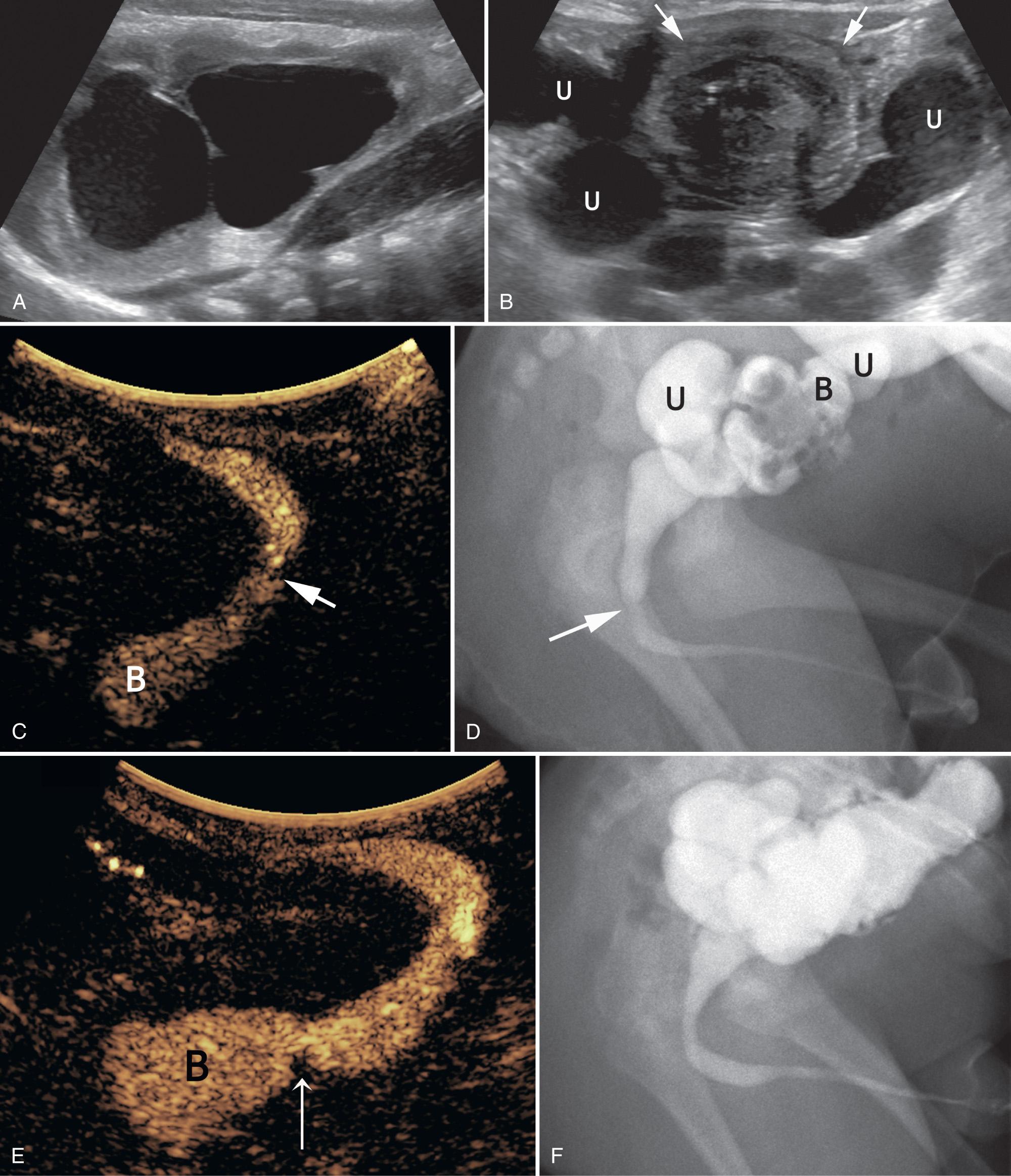 FIG. 52.19, Bilateral Hydronephrosis Secondary to Posterior Urethral Valves.