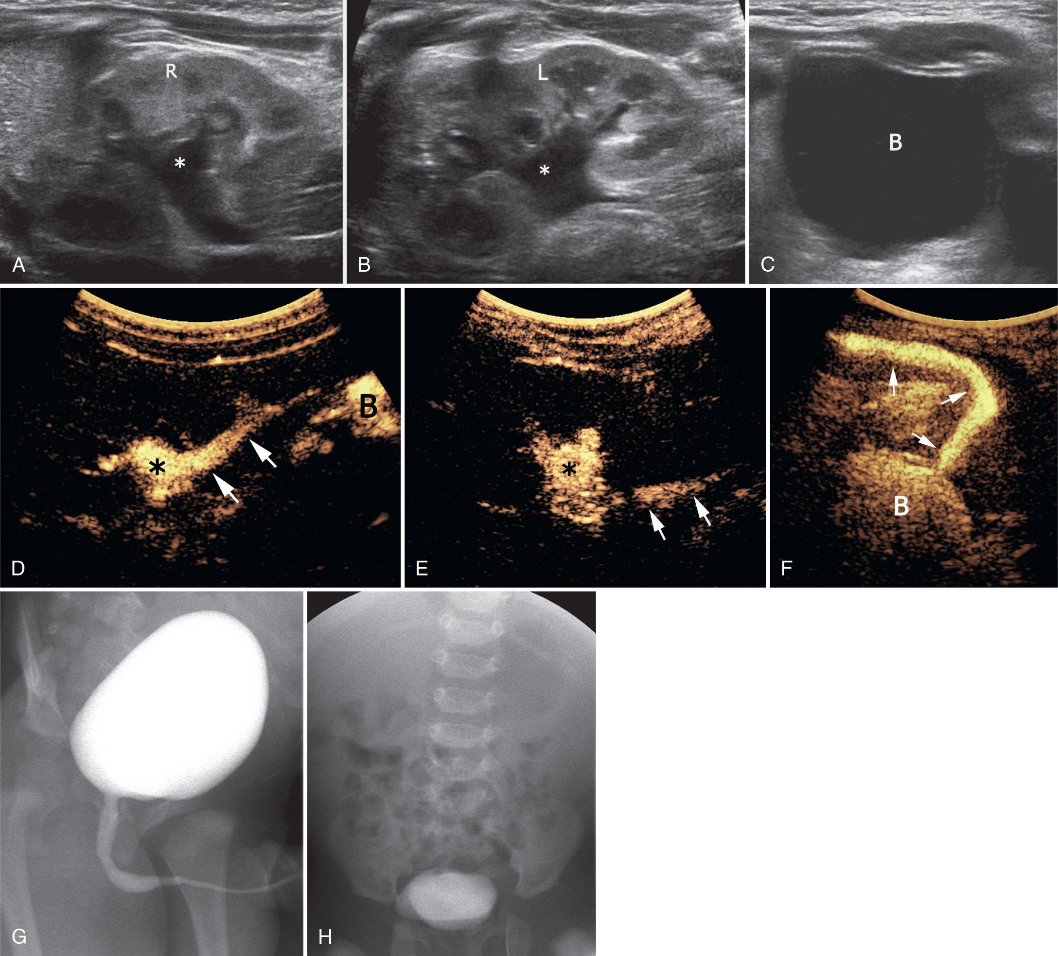 FIG. 52.20, Hydronephrosis Secondary to Vesicoureteral Reflux Depicted by Contrast-Enhanced Voiding Urosonography.