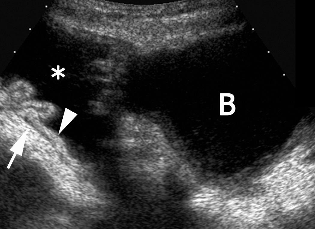 FIG. 52.22, Sigmoid Cystoplasty in Patient With History of Bladder Exstrophy.