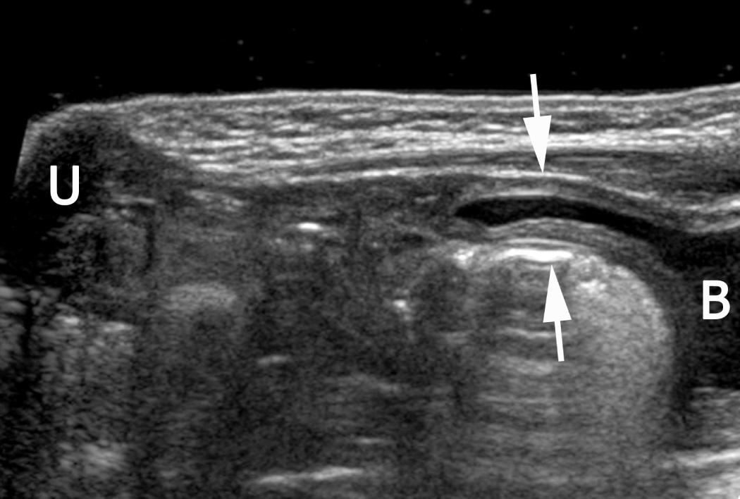 FIG. 52.24, Vesicourachal Diverticulum.