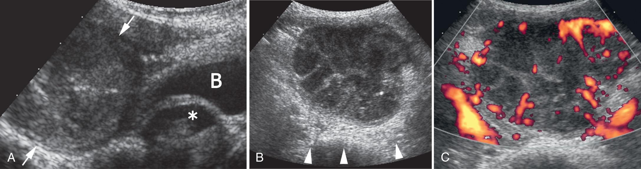 FIG. 52.25, Infected Urachal Cyst.