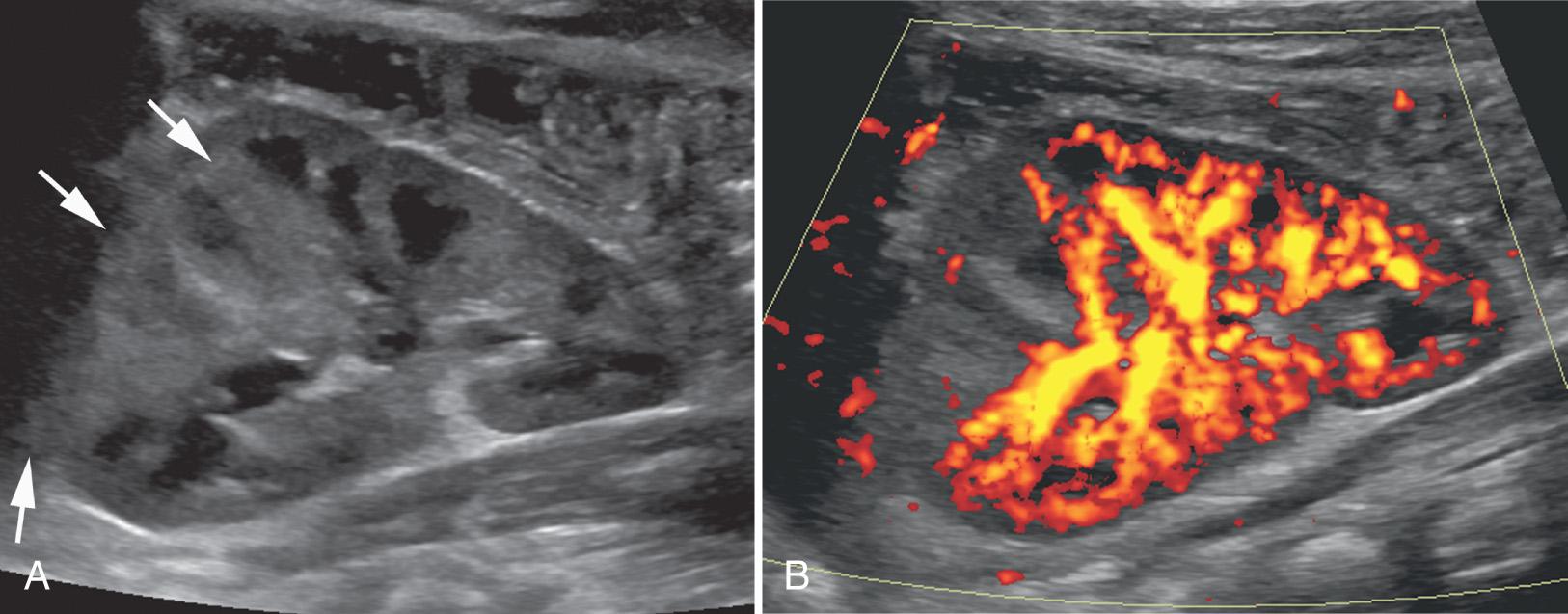 FIG. 52.26, Acute Pyelonephritis in 2-Month-Old Girl.