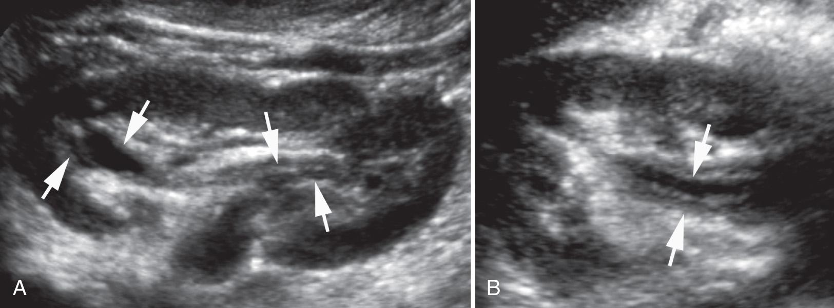 FIG. 52.27, Thickening of the Renal Pelvic Wall.