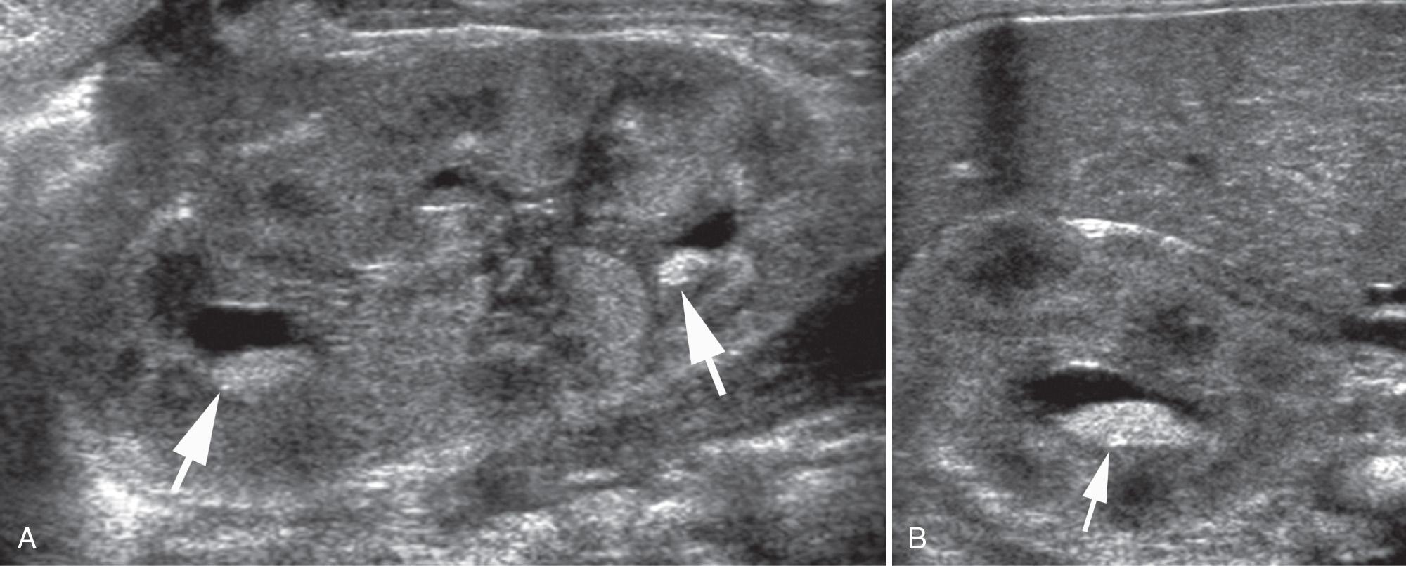 FIG. 52.31, Renal Candidiasis in a Premature Neonate.