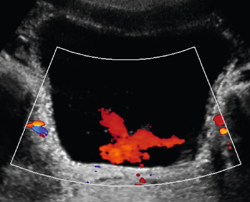 FIG. 52.5, Ureteral Jets.