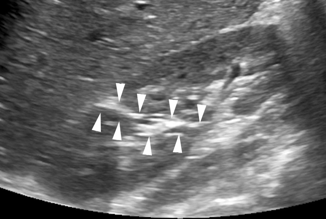 FIG. 52.7, Renal Junctional Parenchymal Defect.