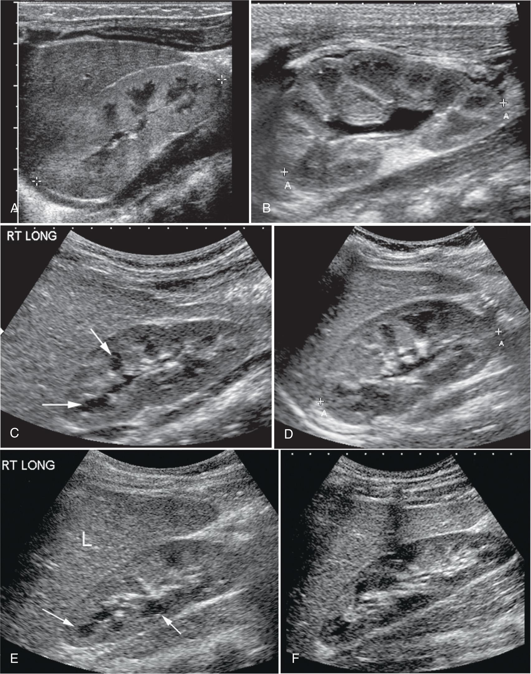 FIG. 52.8, Normal Renal Appearances at Different Ages.