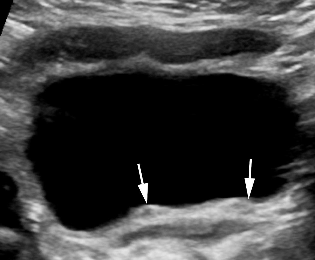 FIG. 52.9, Normal Distal Ureters.