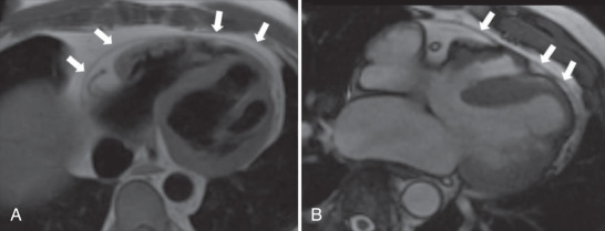 FIG. 46.1, (A) Axial T1-weighted spin echo image of the normal pericardium (arrows). (B) Steady-state free precession four-chamber view demonstrating normal anterior pericardium (arrows) .