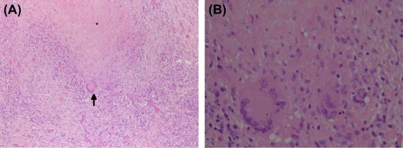 FIGURE 16.1, (A, B) Sections show a caseating (asterisks) granuloma, surrounded by chronic inflammation and a multinucleate giant cell (black arrow) in tuberculous pericarditis. (Stains: (A&B) hematoxylin and eosin; original magnification: A x10; B x20).