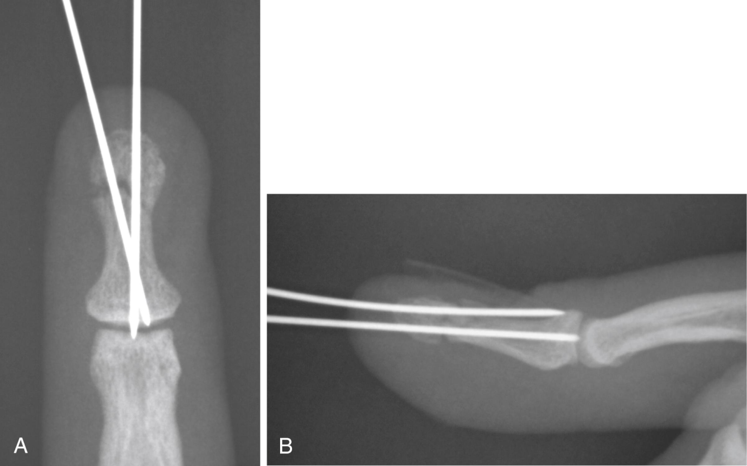 Fig. 9.11, A and B, Distal phalanx fractures with Kirschner wire fixation.