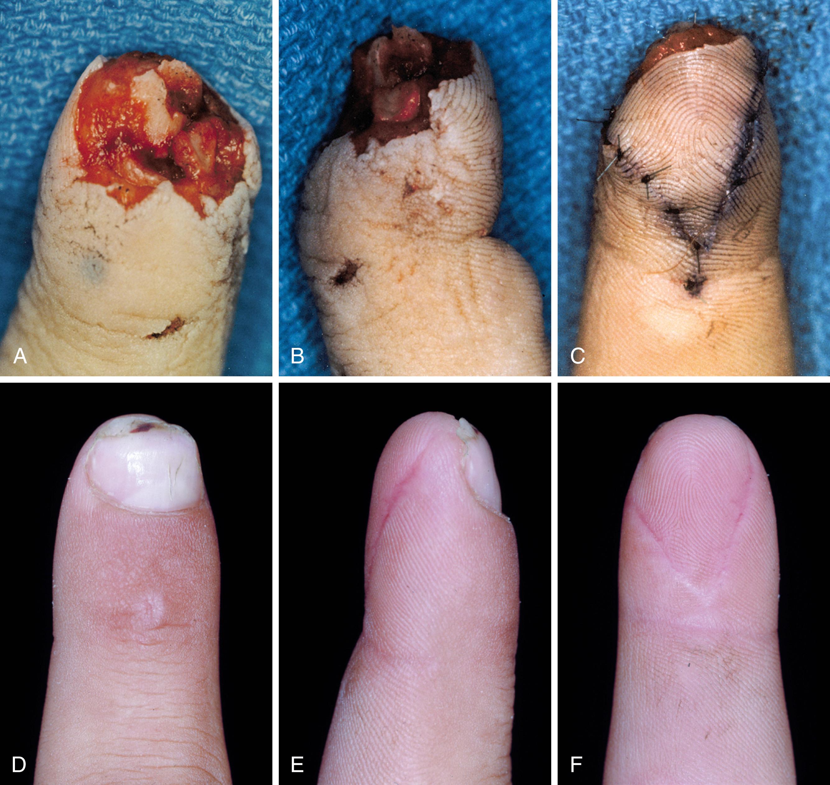 Fig. 9.12, A, Fingertip injury with avulsion of nail bed. B, Dorsal tip defect with intact volar skin. C, “V-Y” volar advancement flap for coverage and nail bed support. D to F, Results after partial nail regrowth.