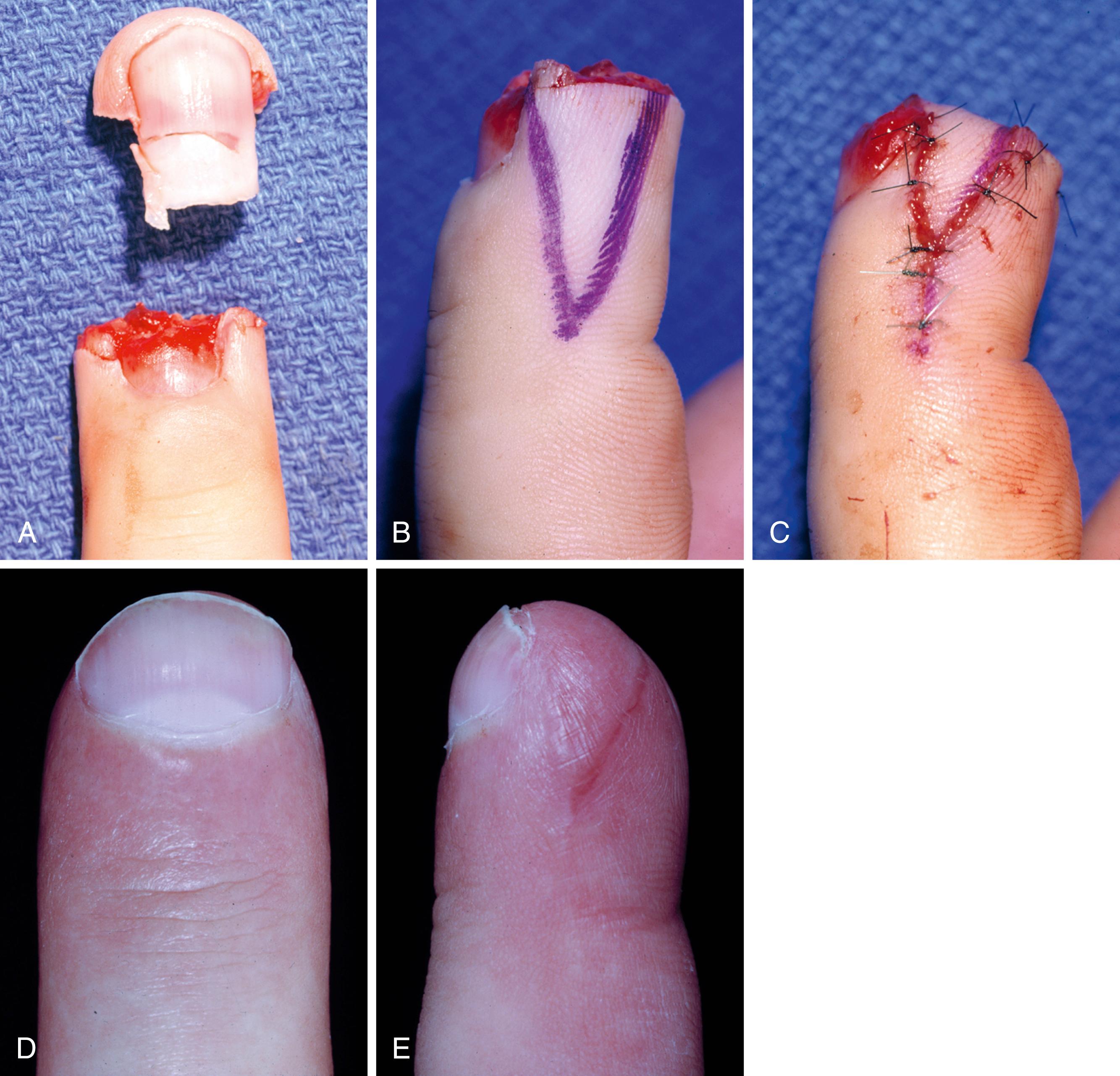 Fig. 9.13, A, Fingertip amputation through the sterile matrix. B, Outline of bilateral “V-Y” advancement flaps for soft tissue coverage of fingertip. C, Flaps advanced and sutured together in midline. D and E, Appearance after regrowth of nail.