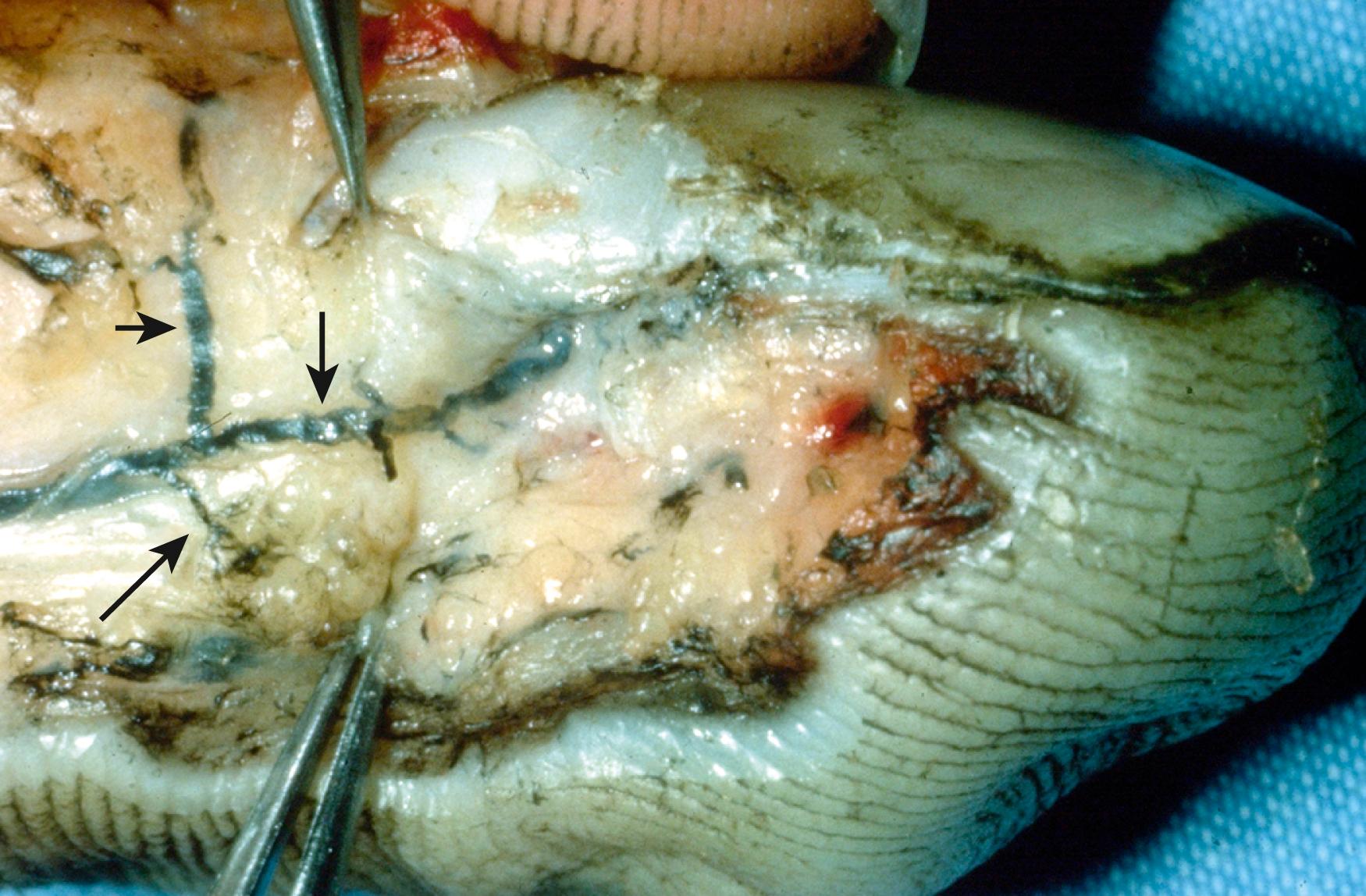 Fig. 9.2, Small arrow shows common volar digital artery, medium arrow indicates dorsal branch to the nail fold, and large arrow shows artery that progresses along the perionychium and sends branches to the nail bed. The terminal branch to the pad of the finger is not shown.