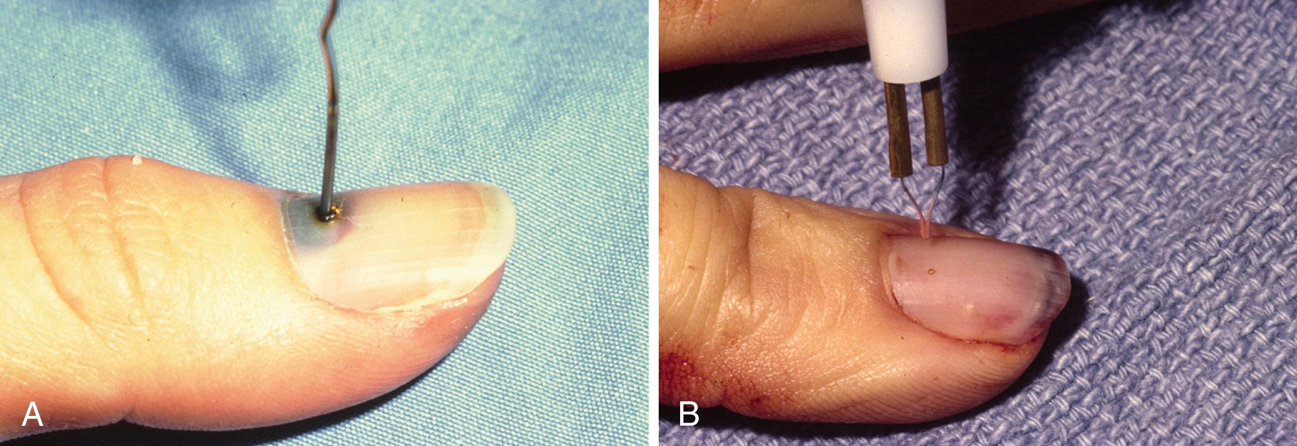 Fig. 9.4, A, A time-honored method of burning a hole through the nail is with a heated paperclip. B, The authors’ preferred method of burning a hole through the nail is with an ophthalmic battery-powered cautery.