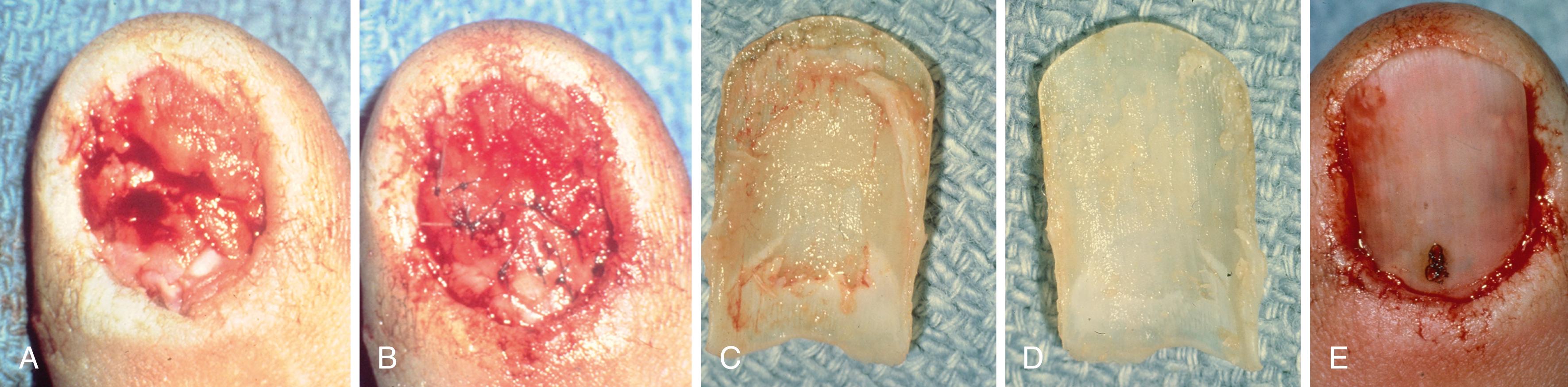 Fig. 9.5, A, Stellate laceration of nail bed is visible after the nail is removed. B, The lacerations are approximated with 7-0 chromic suture under loop magnification. C, Undersurface of the removed nail with residual soft tissue. D, The undersurface of the nail after it has been cleaned and soaked. E, A hole large enough to allow drainage has been burned through the nail and the nail has been inserted back into the nail fold.