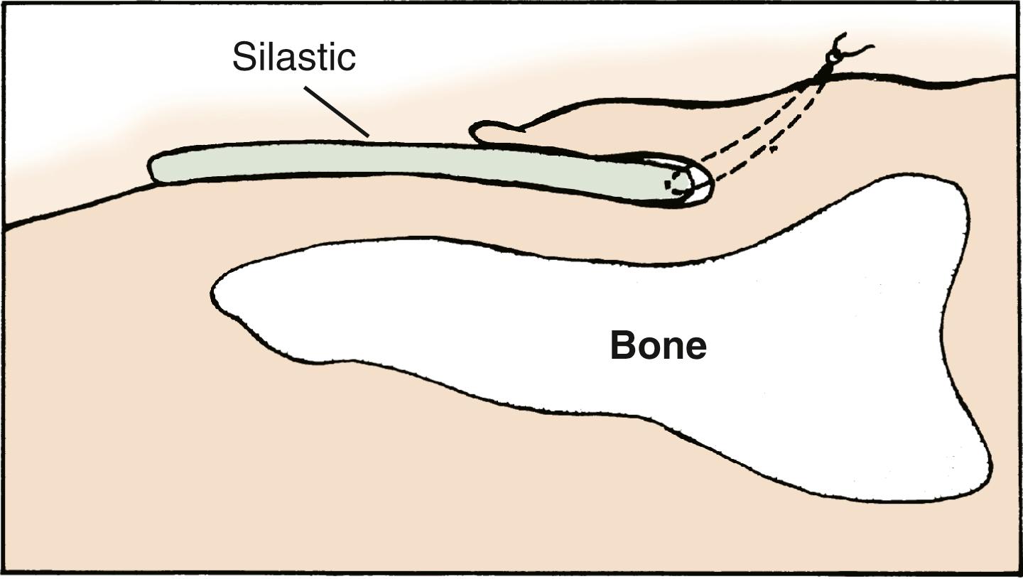 Fig. 9.6, Horizontal mattress suture through the nail wall is used to hold a silicone sheet in the nail fold.