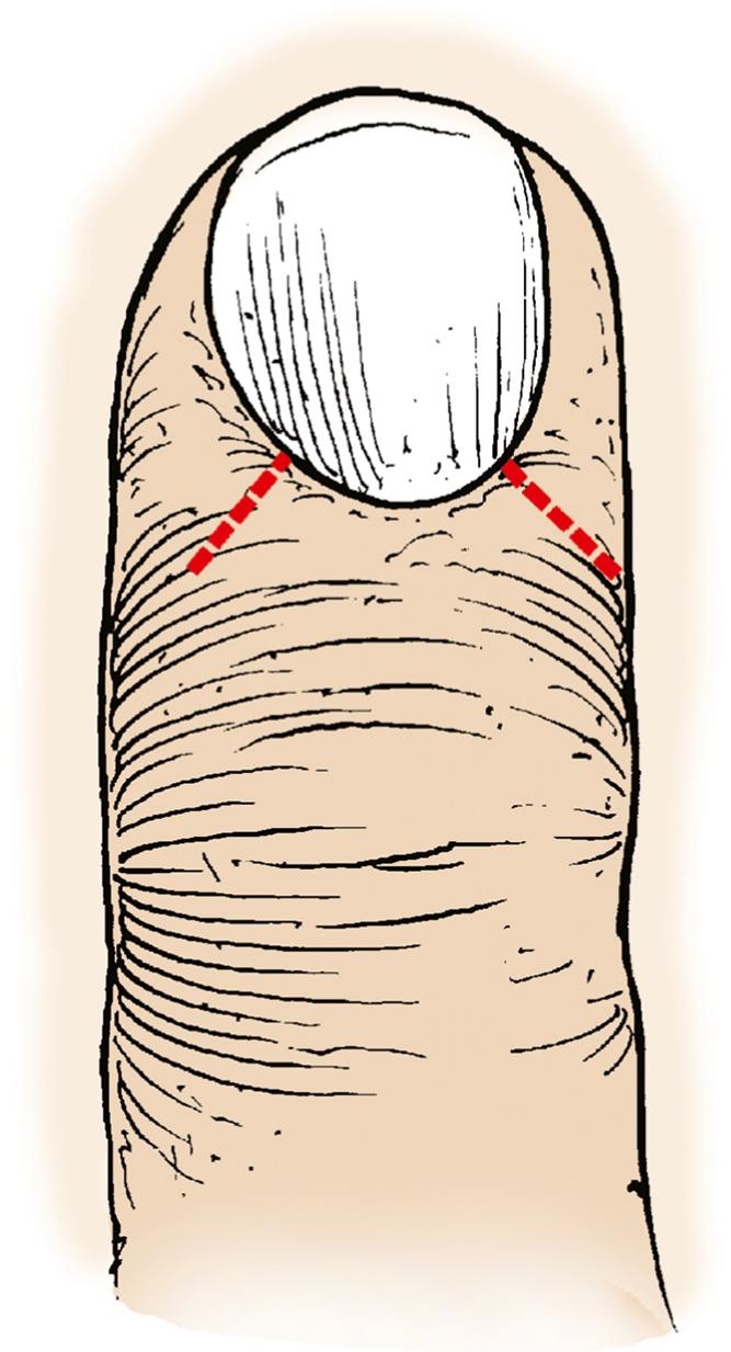 Fig. 9.7, When incisions are made in the eponychium, they should be made at 90-degree angles from the eponychium to prevent deformity.