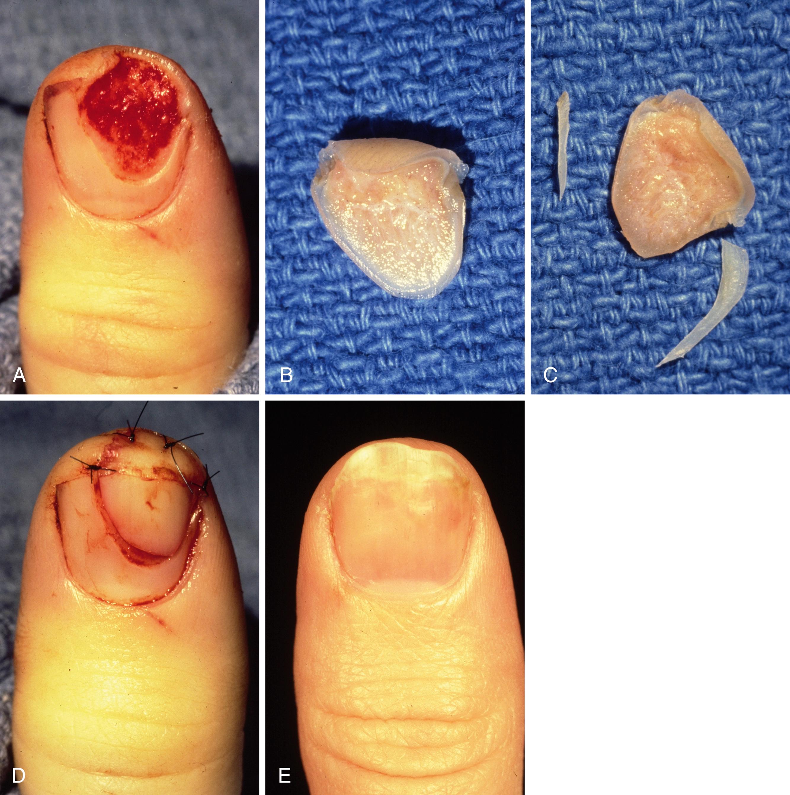 Fig. 9.8, A, Avulsion of a small portion of the nail and nail bed. B, Undersurface of the nail fragment with attached nail bed. C, Only that portion of the nail that is overhanging the nail bed is removed. D, The nail with attached nail bed is accurately approximated and held in place with a few fine chromic sutures. E, Nail bed 12 months after injury.