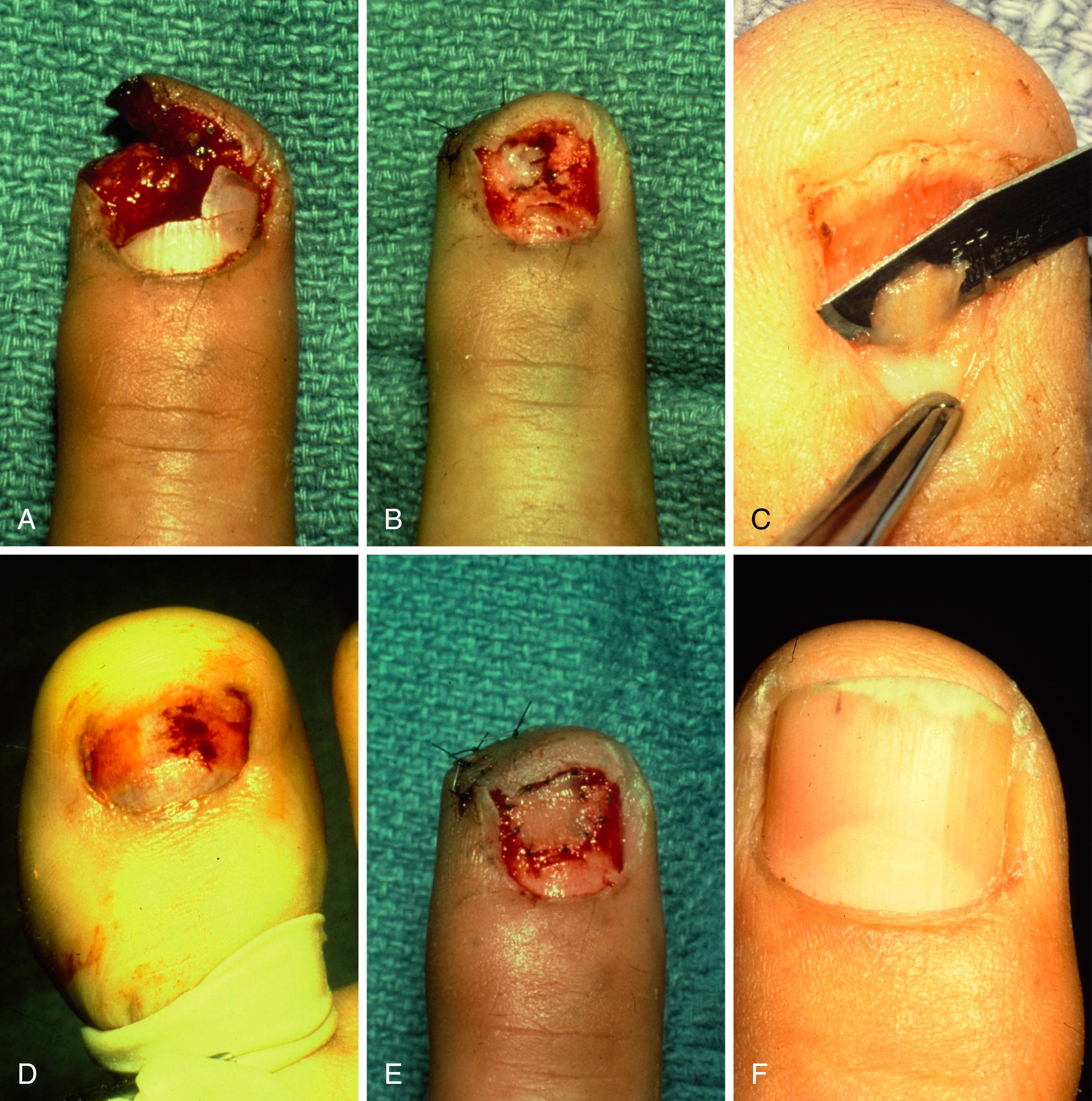 Fig. 9.9, A, Nail bed and fingertip injury with avulsion of approximately 25% of the nail bed. B, Tip skin and nail bed surrounding the avulsion have been repaired. The white area at the distal left portion of the nail bed is bare cortical bone of the distal tuft. C, Technique of harvesting a small, split-thickness nail bed graft. D, Large toe after the nail has been removed and a split-thickness graft has been removed from the sterile matrix. The germinal matrix should not be included in a split-thickness graft. E, Split-thickness graft of sterile matrix is sutured in place on the nail bed. F, Fingernail 1 year later.