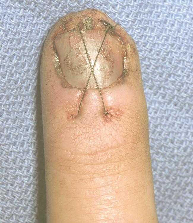 Fig. 9.10, Figure-of-eight stitch holds nail in place and adds stability to fracture.