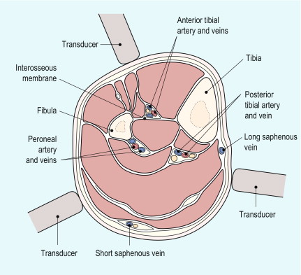 FIGURE 4-2, Cross-section of calf, showing major relations of calf arteries and the three main access points for demonstrating these vessels.