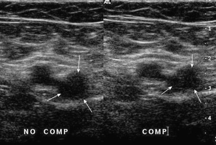 FIGURE 5-12, Positive compression test, the thrombosed vein (arrows) does not change calibre on compression with the transducer.