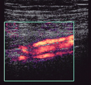 FIGURE 5-2, Power Doppler showing paired deep calf veins running with the artery.
