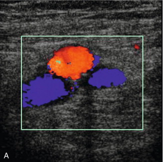 FIGURE 5-3, (A) Transverse view showing dual superficial femoral vein segments; (B) another example of multiple superficial femoral vein segments showing a central artery (aliased colour signal seen as red) with four venous channels adjacent to it.