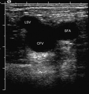 FIGURE 5-4, The saphenofemoral junction showing the ‘Mickey Mouse’ view.