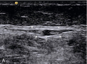 FIGURE 5-7, (A) The small saphenous vein (arrow) in the posterior calf lying in the fascial triangle (arrowheads) formed between the superficial fascia and the deeper muscular fascia; (B) colour Doppler showing the small saphenous vein (arrow) and a muscule vein (arrowheads) deep to the fascia which might be mistaken for the SSV if its location is not recognised.