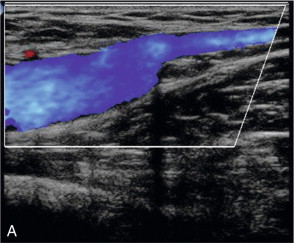 FIGURE 5-9, The common femoral vein showing (A) complete colour fill-in across the vein lumen in a normal vein: (B) only a small residual lumen in a partially thrombosed vein.