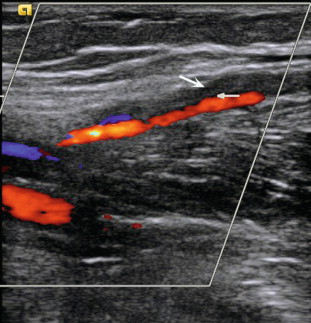 FIGURE 5-10, Thrombosis in the gastrocnemius vein (arrows). The popliteal vein was patent.