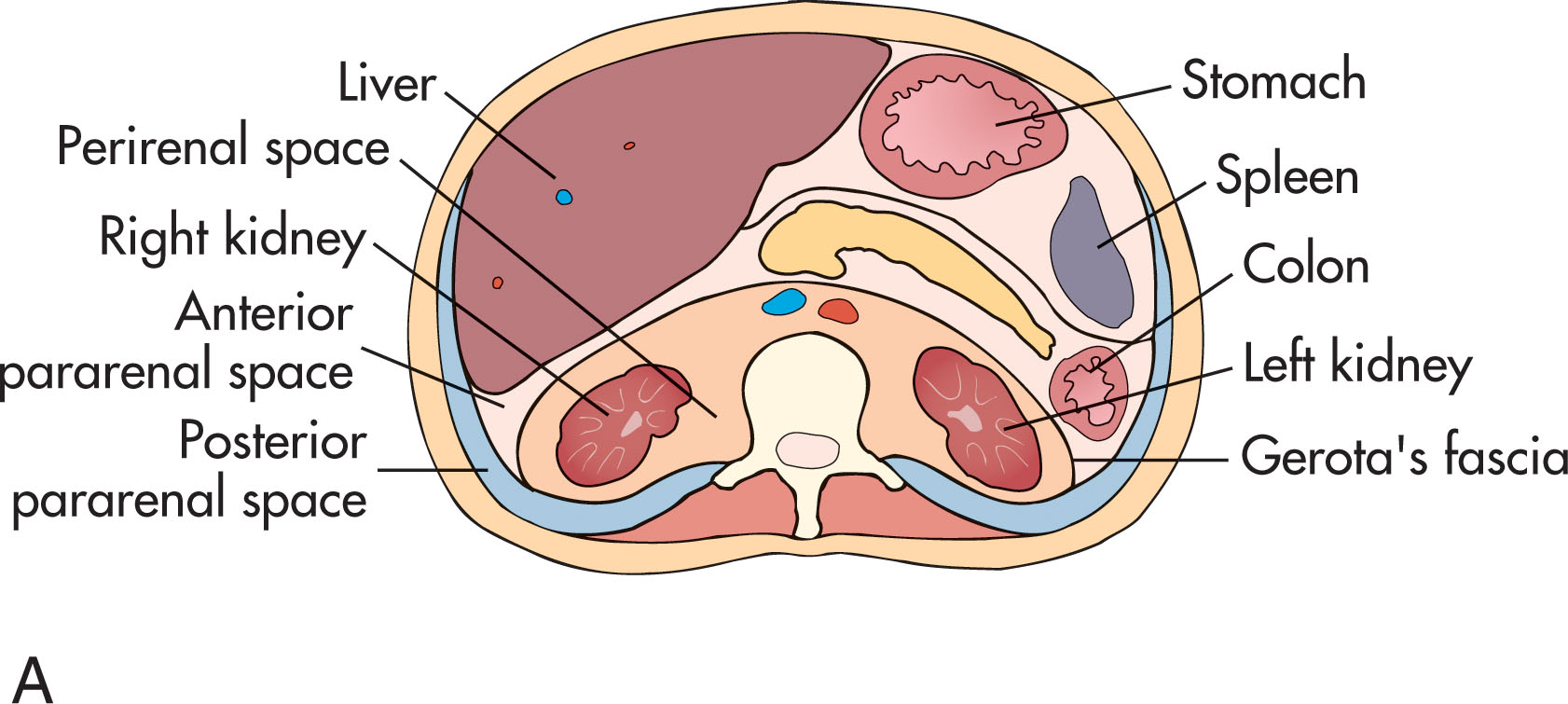 Fig. 14.11, (A) Transverse view of the retroperitoneal space. (B) Enlarged lymph nodes surrounding the inferior vena cava. (C) Computed tomographic presentation of an enlarged node (arrow) .