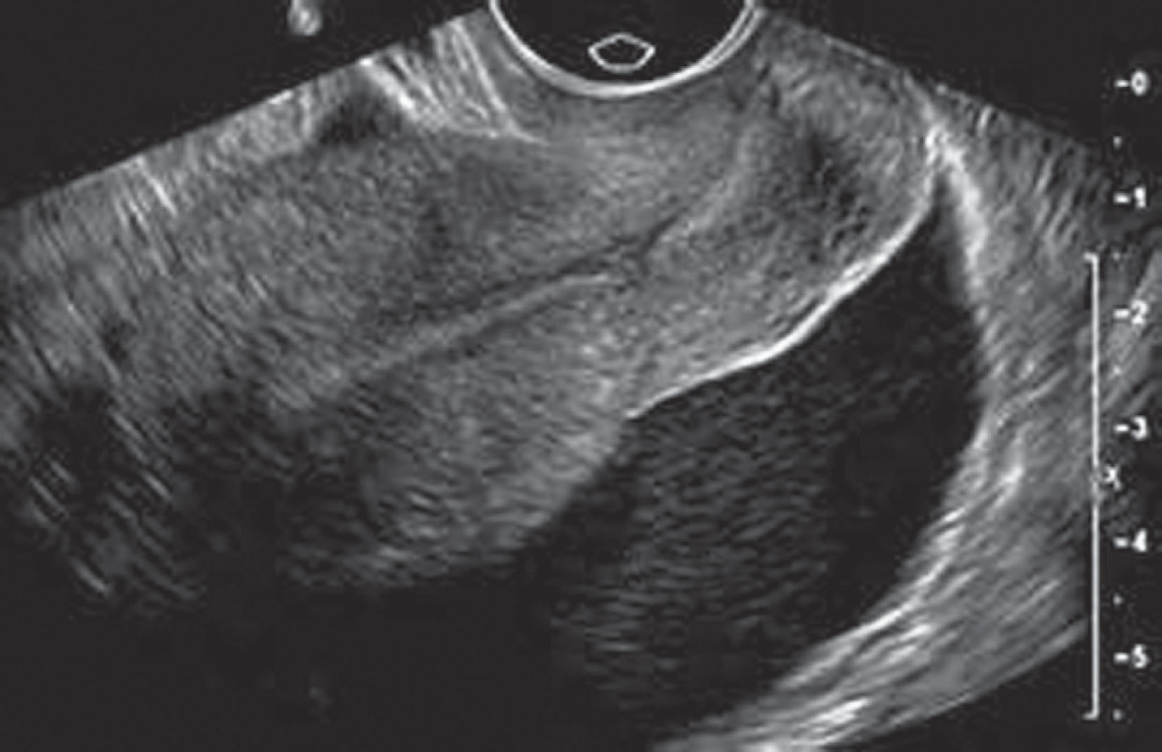 Fig. 14.15, Transvaginal image of fluid in the extraperitoneal prevesical space displacing the uterus anteriorly.