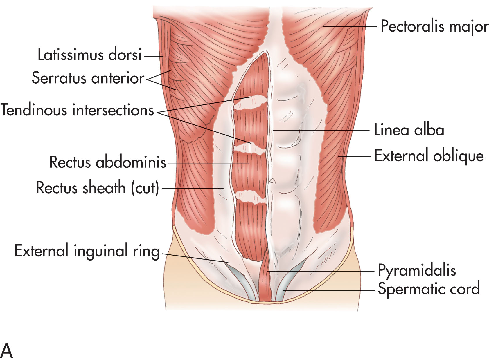 Fig. 14.16, (A) The rectus abdominis muscle rises from the front of the symphysis pubis and the pubic crest. (B) The muscles of the anterior and lateral abdominal walls include the external oblique, internal oblique, transversus, rectus abdominis, and pyramidalis.