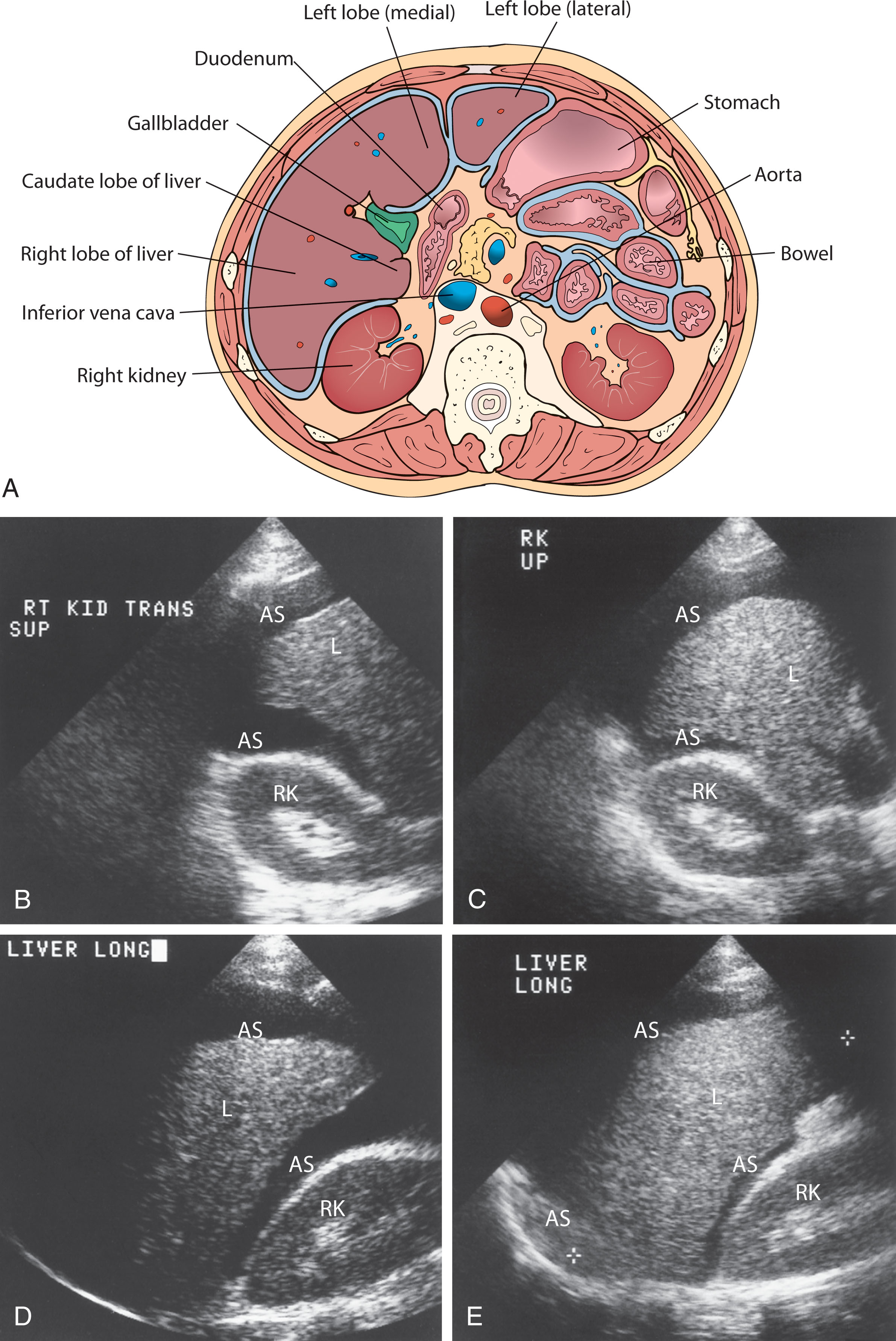 Fig. 14.17, (A) Transverse view of the posterior pararenal space. This space is located between the posterior renal fascia and the transversalis fascia. It communicates with the peritoneal fat, lateral to the lateroconal fascia. The space merges inferiorly with the anterior pararenal space and retroperitoneal tissue of the iliac fossa. Ascites may fill the peritoneal cavity. Small volumes of fluid in the supine position first appear around the inferior tip of the right lobe of the superior portion of the right flank. (B–C) Transverse views show ascitic fluid in the pararenal and subhepatic spaces. (D–E) Longitudinal views with ascitic fluid in the pararenal space (Morison’s pouch) and subhepatic space. AS , Ascites; L , liver; RK , right kidney.